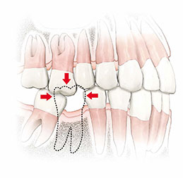 Missing Posterior Tooth